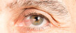 Close up of a eye of a senior man affected by pterygium