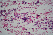 Microscopic image of ovarian tumor. Serous papillary cancer
