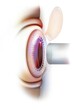 Eye: laser operation (here Lasik) to correct refractive errors.