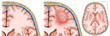En esta Ilustración descriptiva podemos ver el cerebro sano y con un tumor cerebral, Estos tumores pueden ser benignos o malignos. 