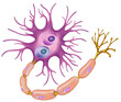Ilustración de una neurona cerebral en la demencia con cuerpos de Lewy, enfermedad o síndrome degenerativo y progresivo del cerebro. 