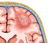 Fototapeta  - Ilustración descriptiva de un tumor cerebral, esta masa o bulto de células anormales afectará el funcionamiento del sistema nervioso. 