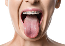 Woman With Dental Braces Showing Tongue On White Background, Closeup