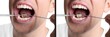 Collage with photos of man before and after professional treatment of dental plaque on white background, closeup. Banner design