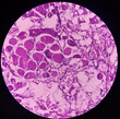 Micrograph of verrucae or chin skin wart, microscopic show epidermal hyperplasia with hyperkeratosis and papillomatosis. dense infiltration of polymorphs, lymphocytes, histiocytes.