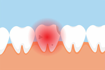 Canvas Print - Dead tooth hurting and giving a red pain signal concept. A bad tooth with cavities and a red danger signal. Dental infographic elements vector with a dead tooth. Stomatology care for teeth.