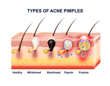 Skin Acne Anatomy Composition