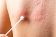 © sashka1313 - cotton swab treatment of skin rash. Shingles, varicella-zoster virus. skin rash and blisters on body. Skin infected Herpes zoster virus. Herpes Virus on body. urticaria rash. atopic dermatitis