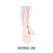 Arterial line catheter placed in the radial artery on the wrist. Critical care art line for arterial blood gas analysis and monitoring pressure. Medical vector illustration.