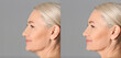 Double chin problem. Collage with photos of mature woman before and after plastic surgery procedure on grey background, banner design