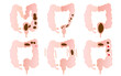 Vector illustration set of constipation types.