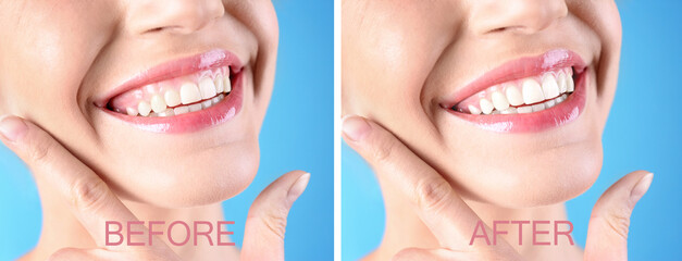 young woman before and after gingivoplasty procedure on light blue background, closeup. banner desig