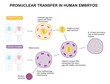 Pronuclear transfer in human embryo infographic diagram patient and donor couple mitochondria fertilized egg healthy DNA nucleus removed free of disease vector for medical science education