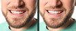 © New Africa - Young man before and after gingivoplasty procedure, closeup. Banner design