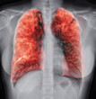  Lung 3D rendering image for diagnosis TB,tuberculosis and covid-19 from CT-Scanner 3D.