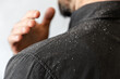 A bearded man in a black shirt shakes dandruff of his shoulder. Close-up. The concept of psoriasis and seborrheic dermatitis