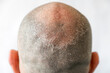 Males bald flaky head with dandruff close-up, back view. White background. The concept of psoriasis and dandruff