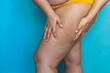 © Юля Бурмистрова - Cropped photo of fat plump overweight woman standing in yellow swimming trunks, showing cellulite of skin on leg, orange peel on blue background. Cellulite, obesity, deposition of subcutaneous fat.