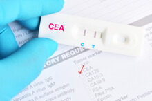 CEA Or Carcinoembryonic Antigen Positive By Using Rapid Test, Colorectal Cancer Diagnosis, Sample From Blood 