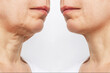 Lower part of face and neck of elderly woman with signs of skin aging before and after facelift, plastic surgery isolated on white background. Age-related changes, flabby sagging skin. Platysmoplasty