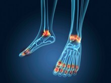 X-ray View Of Inflamed Foot Bones
