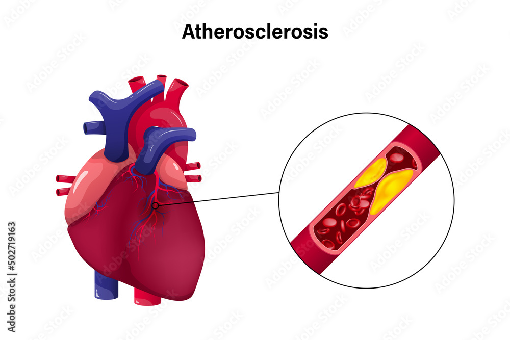 Atherosclerosis with heart vector concept. Coronary Artery Disease ...