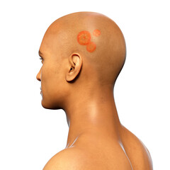 Sticker - Fungal infection on a man's head, 3D illustration