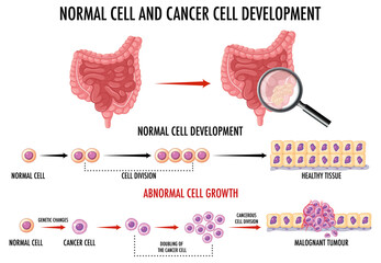 Wall Mural - diagram showing normal and cancer cells