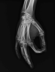 Enchondroma of the hands demonstrates a well-defined, lucent, central medullary lesion with thinned cortex proximal of the phalanx proximal 4th finger, as well as patological fraktur.