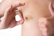 male nipple injured bruise and hematoma close-up. disease