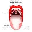 Oral thrush. A white coating on the tongue and White patches in throat.
