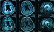 A snapshot of an elderly person's brain scan on magnetic resonance imaging MRI film, for neurological medical diagnosis of brain diseases