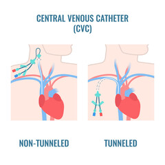 Tunneled and non-tunneled central venous catheters placed in the jugular and subclavian veins. CVC access device placement types. Medical vector illustration.