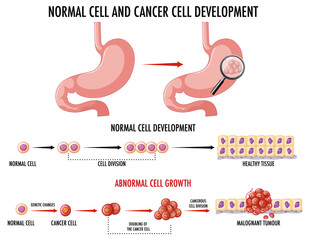 Wall Mural - diagram showing cancer development process