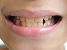 Child With Yellow Teeth. Closeup Photo, Blurred.