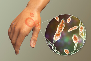 Sticker - Fungal infection on a man's hand. Tinea manuum and close-up view of dermatophyte fungi