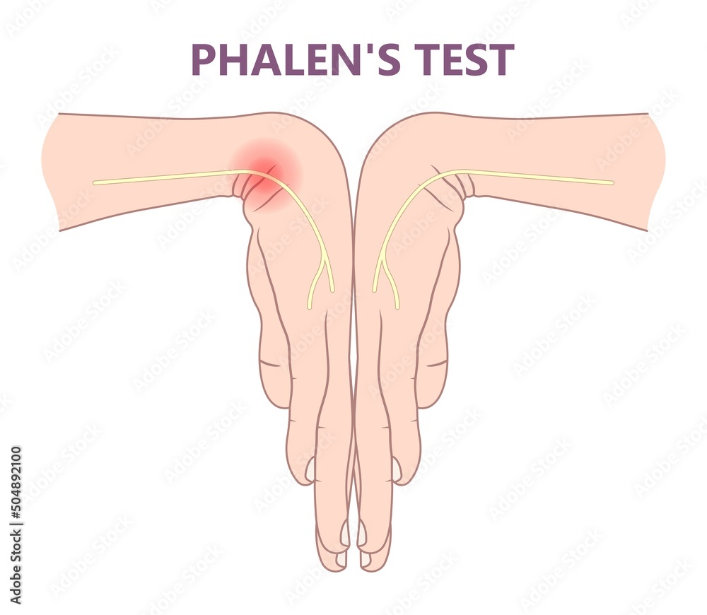 Vector de Stock Phalen test diagnose wrist flexion bend hand nerve