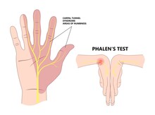 Phalen Test Diagnose Wrist Flexion Bend Hand Nerve Compression Pain Treat Ache Arm Weak Thump Tinel Sign Elbow Ulnar Guyon Canal Two Point Numb Durkan Tendon Exam De Quervain's