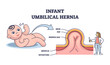 Infant umbilical hernia as painless lump near belly button outline diagram. Labeled educational scheme with newborn children stomach with skin, fat, sac, muscle and intestine vector illustration.
