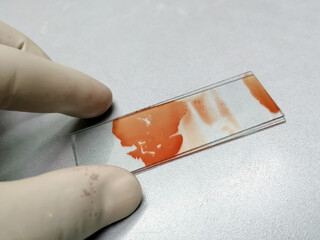 Sticker - Hand of histologist prepare cytological slide from FNAC sample.