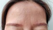 © Rung Kh - Portrait showing the flabbiness skin on the forehead, problem flabby skin and wrinkles on the face of the woman, concept health care.