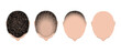 Hair loss bald head alopecia transplant growth vector top view. Hair loss men top view alopecia scalp problem