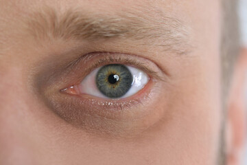 Tired man with dark circle under eye, closeup