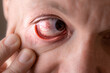 Subconjunctival hemorrhage - hyposphagma. Close up of man's face showing red bloodshot eye.
