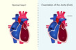 The difference of Normal heart and Coarctation of the Aorta vector. Congenital heart disease.