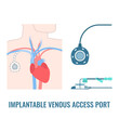 Implantable venous access port on male body
