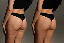 Buttocks And Hips Woman With Cellulite And Stretch Marks Close-up Before And After Liposuction Procedure And Cosmetic Therapy