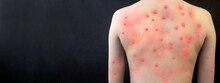 MONKEYPOX. The Girl's Skin Is Blistered From Monkeypox. Virus, Epidemic, Disease. Black Background.