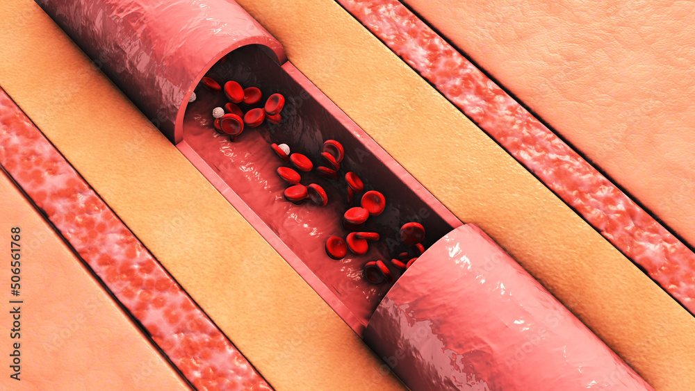 Vascular atherosclerosis cutaway blood vessel Stock Illustration ...