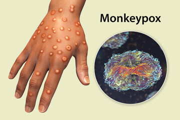 Sticker - Hand of a patient with monkeypox infection, 3D illustration